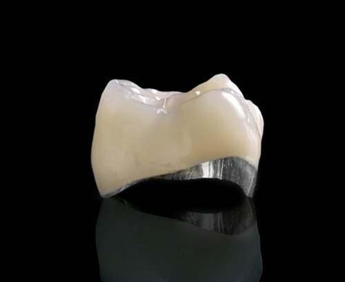 Porcelain fused to Metal