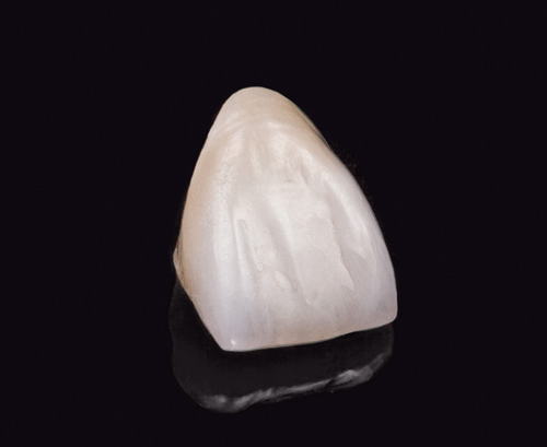 P.F.Z (Porcelain Fused to Zirconia)